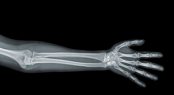 Xray of an arm. Image from Gothic Wings.